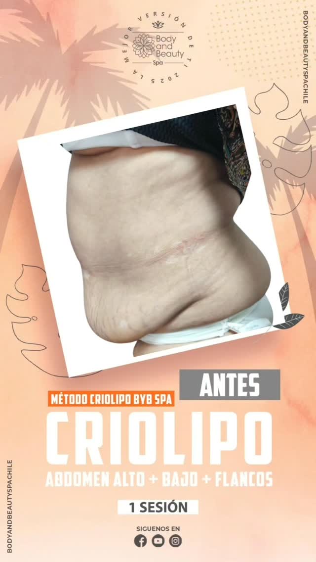 Tratamiento 10